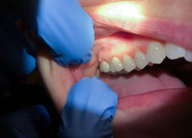 Best Emergency Dental Care for Broken or Chipped Teeth in New Holstein, WI